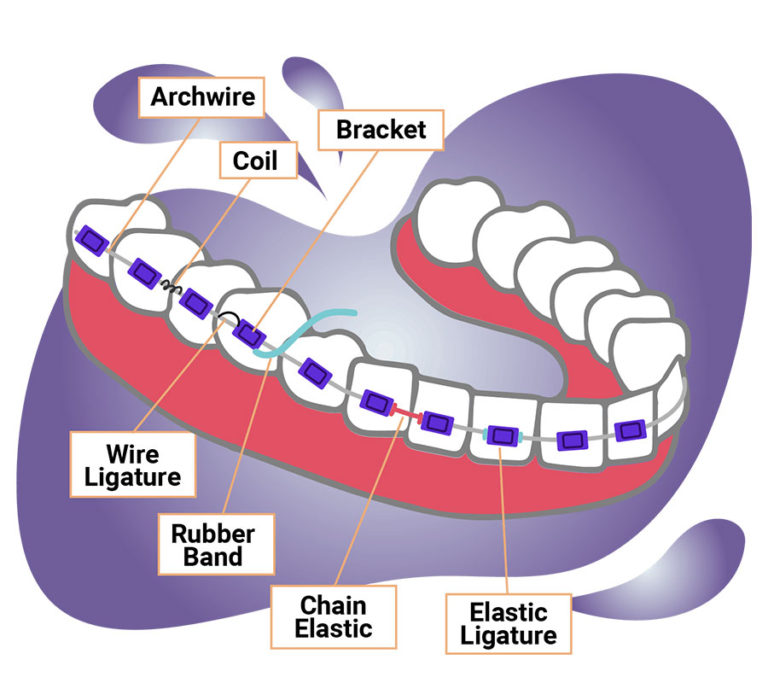 Orthodontic Treatment In Nagpur Orthodontics Orthodontist In Nagpur