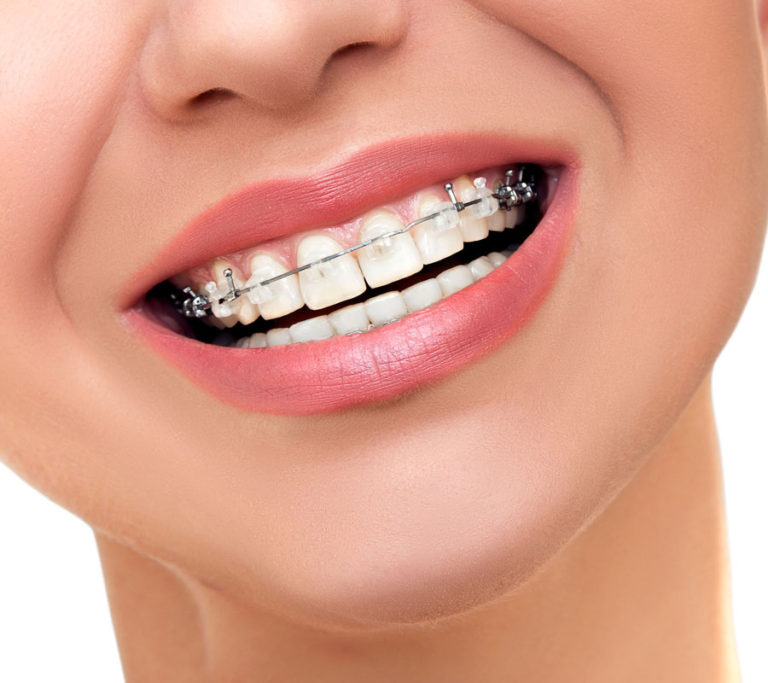 Aesthetic Braces in Nagpur - Aesthetic Braces Treatment by Dr. Jamila