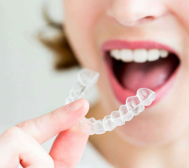 invisible braces cost in india