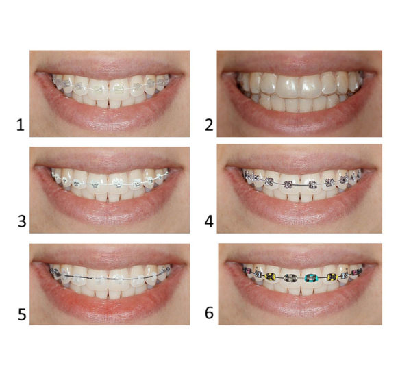 Aesthetic Braces In Nagpur Aesthetic Braces Treatment By Dr Jamila